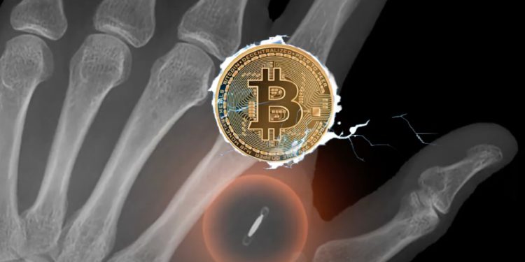 22293e72-40f4-4ede-9e46-8b1762f31078 | 動區動趨-最具影響力的區塊鏈新聞媒體 閃電網路人體錢包!瑞士狂粉在手掌植入晶片,刷手完成BTC支付